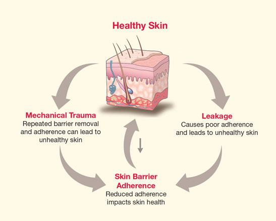 CeraPlus Healthy Peristomal Skin